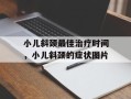 小儿斜颈最佳治疗时间，小儿斜颈的症状图片